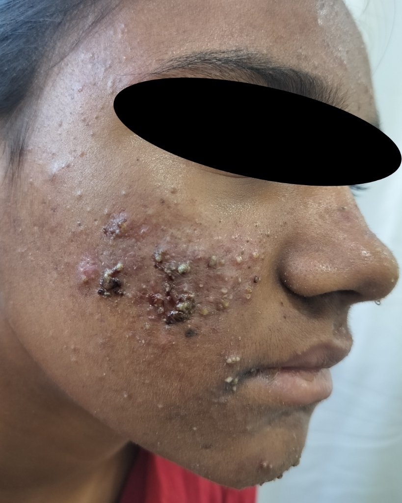 Before Treatment