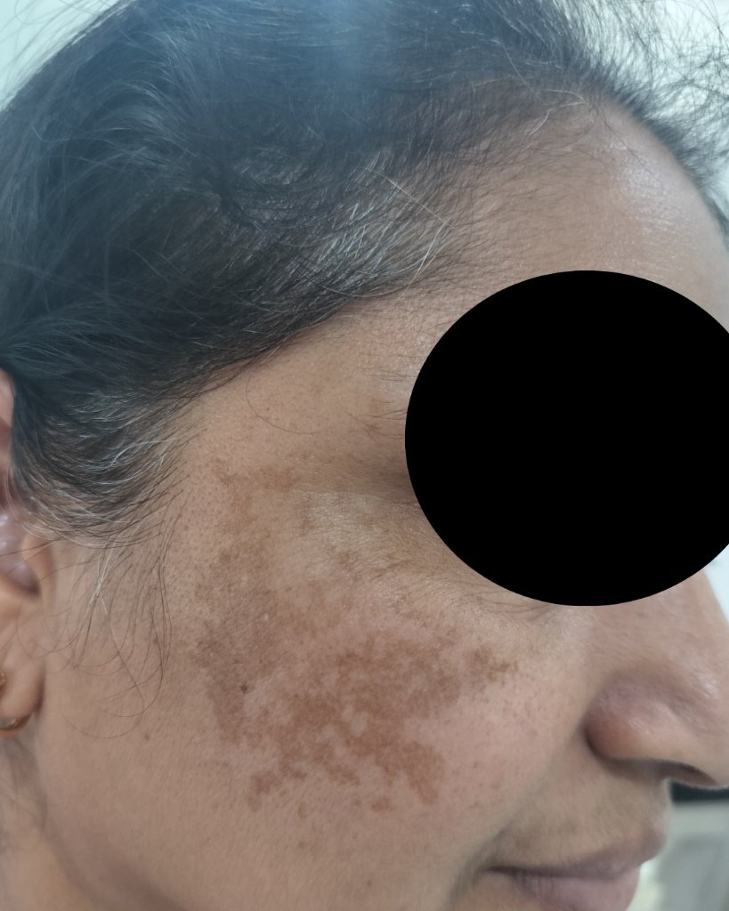 Before (Melasma)