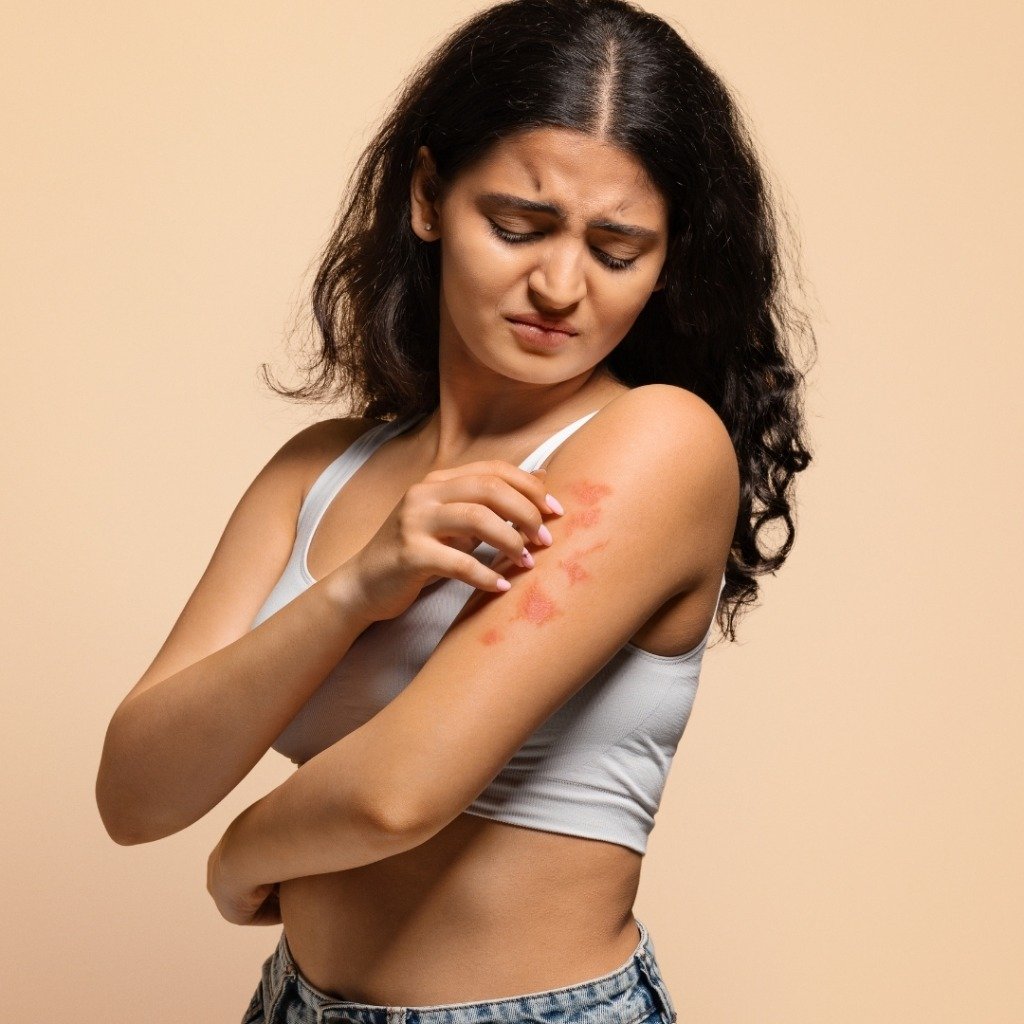 Eczema, Allergies & Urticaria