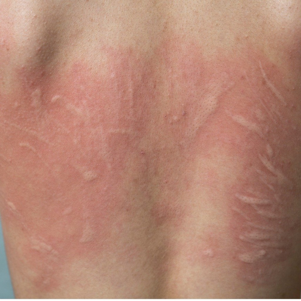 Urticaria & Severe Allergic Hives